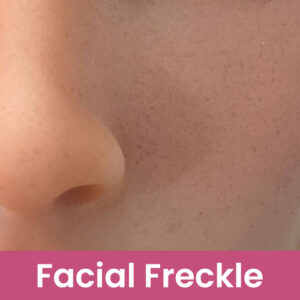 Facial-Freckle
